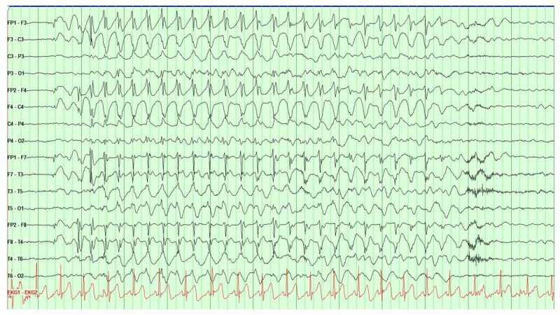 EEG readout showing a generalized 3Hz spike-and-wave discharge during an absence seizure